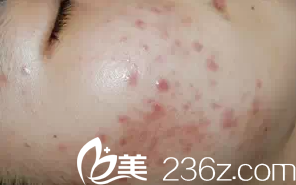 做激光祛痘术前照片 做激光祛痘术前照片