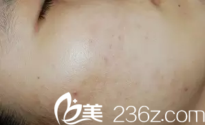 叙述大连美女在韩国海德仁皮肤医院的激光祛痘之行！