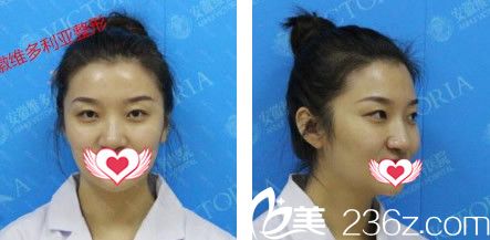 没有去安徽维多利亚整形外科医院做双眼皮之前照片 没有去安徽维多利亚整形外科医院做双眼皮之前照片