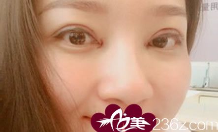 去安徽维多利亚整形美容医院做全切双眼皮手术天 去安徽维多利亚整形美容医院做全切双眼皮手术天