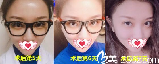 安徽维多利亚整形美容医院徐和林全切法双眼皮术后第5~6天恢复过程图 安徽维多利亚整形美容医院徐和林全切法双眼皮术后第5~6天恢复过程图