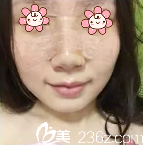 张裕珍院长给我做完五天咯