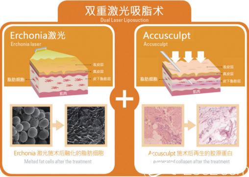 张斗烈研发的双重激光吸脂术 张斗烈研发的双重激光吸脂术