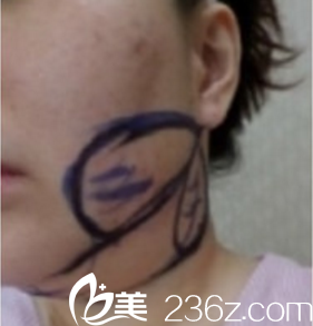 下巴吸脂前画线