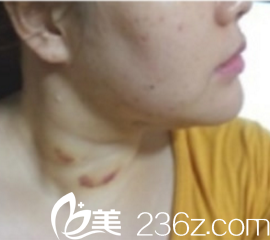 下巴吸脂术后一周