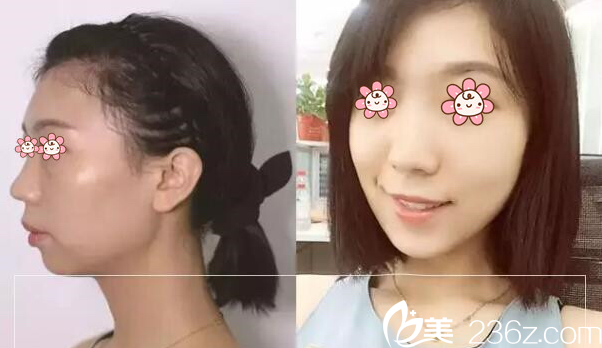 河相旭院长瘦脸除皱瘦脸案例 河相旭院长瘦脸除皱瘦脸案例