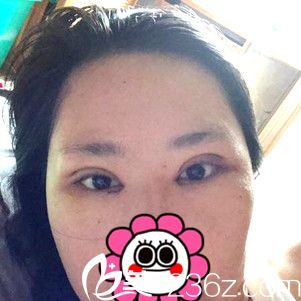 术后三天效果 术后三天效果