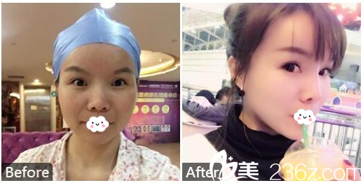 广州美莱雷涛主任脂肪填充和隆鼻案例