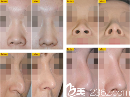 郑载用鼻部整形真人案例展示 郑载用鼻部整形真人案例展示