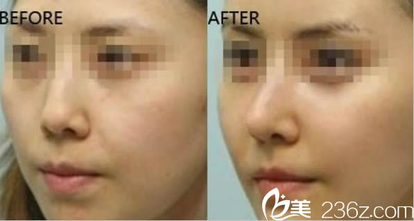 谢常礼鼻综合隆鼻案例对比照