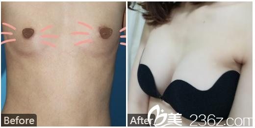 广州美莱雷涛整容医生做的假体隆胸案例