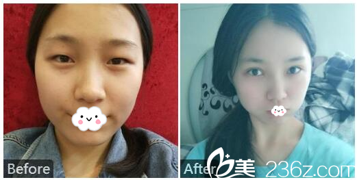 广州美莱雷涛博士做的双眼皮案例