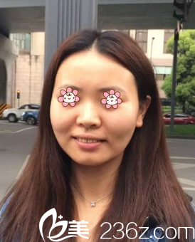 在去韩国丽颖整形外科之前的我 在去韩国丽颖整形外科之前的我