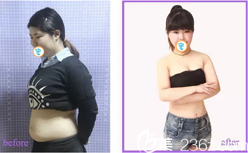 在宜宾韩美做360°环形吸脂已经1个月了 讲讲我瘦脸瘦腰的亲身经历