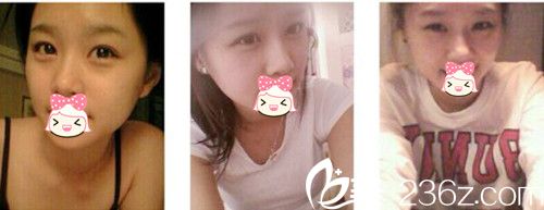 郑州柏丽芙眼部整形术前 郑州柏丽芙眼部整形术前