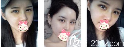 郑州柏丽芙眼部整形术后3天 郑州柏丽芙眼部整形术后3天