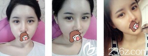 柏丽芙眼部整形后1个月 柏丽芙眼部整形后1个月