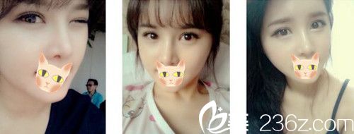 选择在郑州柏丽芙变美 看看我除了眼鼻整形还做了啥项目