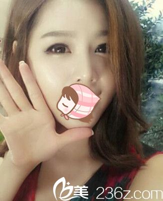 郑州柏丽芙眼部整形案例 郑州柏丽芙眼部整形案例