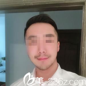 武汉伽美整形玻尿酸垫下巴真实体验 看了前后对比图就知道效果咋样