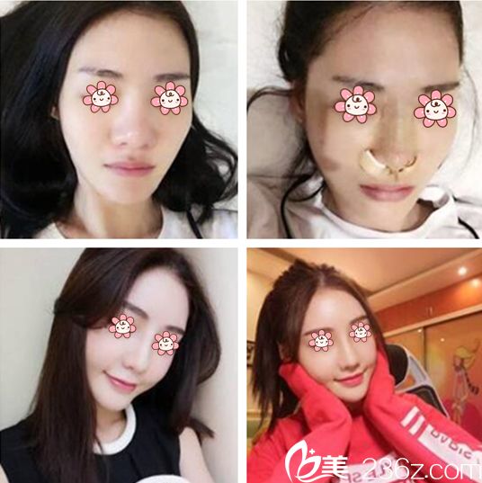 金善球院长鼻整形案例