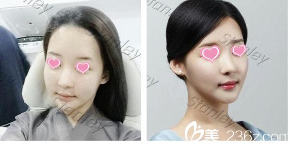 韩国史丹利皮肤整形医院注射案例 韩国史丹利皮肤整形医院注射案例