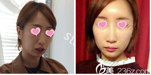 韩国史丹利皮肤整形医院自体脂肪填充案例 韩国史丹利皮肤整形医院自体脂肪填充案例