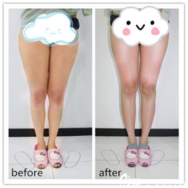 韩国史丹利皮肤整形医院吸脂瘦腿案例