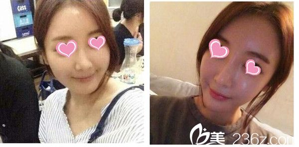 李恩锡院长埋线提升整形手术真人案例 李恩锡院长埋线提升整形手术真人案例