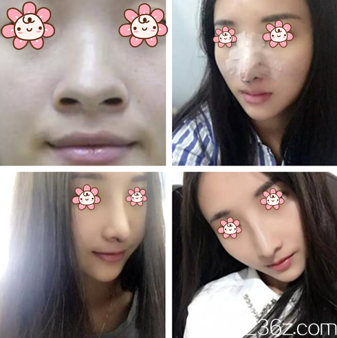 金太焕院长隆鼻案例 金太焕院长隆鼻案例