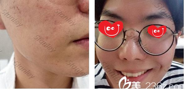 姜仁湖点阵激光去疤痕真人案例