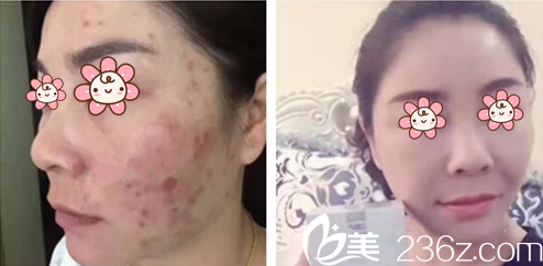 李灿烈院长激光美肤案例 李灿烈院长激光美肤案例