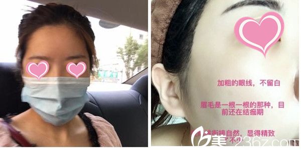 尹聖恩院长纹眉案例 尹聖恩院长纹眉案例