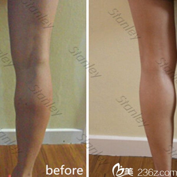 尹珍惠院长瘦腿真人案例 尹珍惠院长瘦腿真人案例