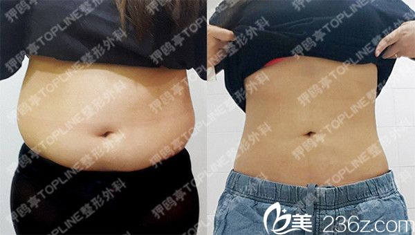 韩国狎鸥亭TOPLINE整形医院腹部吸脂案例 韩国狎鸥亭TOPLINE整形医院腹部吸脂案例