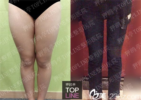 韩国狎鸥亭TOPLINE整形医院腿部吸脂案例 韩国狎鸥亭TOPLINE整形医院腿部吸脂案例