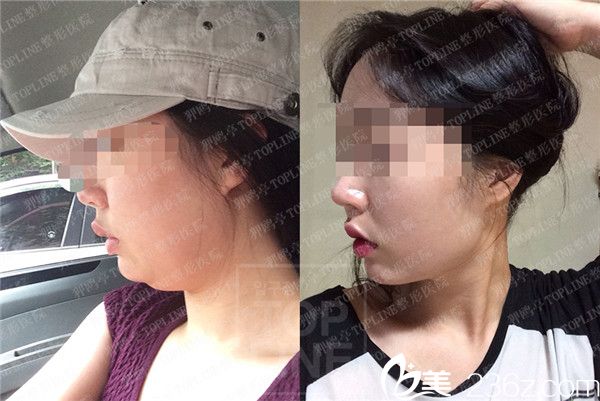 韩国狎鸥亭TOPLINE整形医院脸部吸脂案例 韩国狎鸥亭TOPLINE整形医院脸部吸脂案例