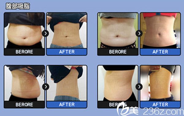 卞相国院长腰部吸脂手术真人案例 卞相国院长腰部吸脂手术真人案例