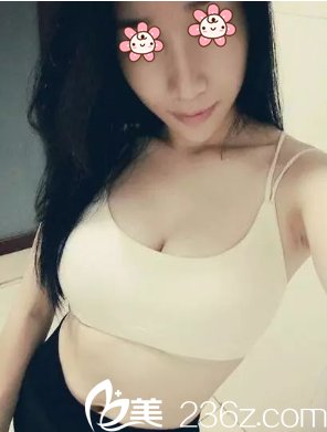 找到一实在关系我就在韩国Cream整形外科做了200CC自体脂肪隆胸