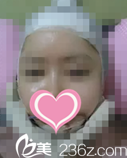 做轮廓手术当天