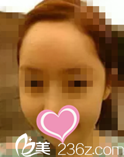 术后一个月效果