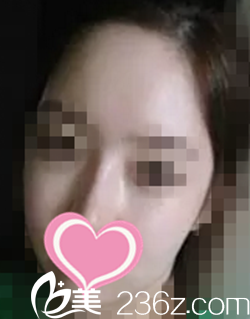 轮廓整形术后2个月效果