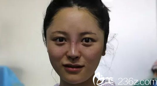 鼻整形手术当天