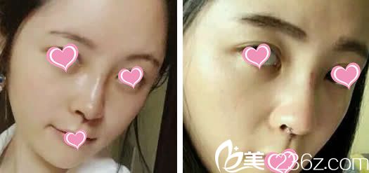 做了假体隆鼻第五天