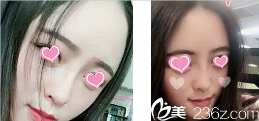 鼻整形15天图片