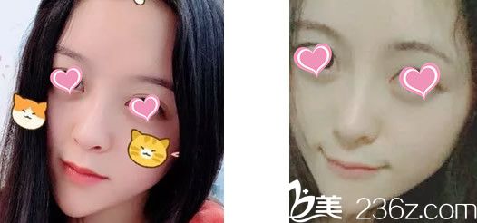 我在兰州圣莫丽斯找彭斌医生做了假体隆鼻 第七天拆线后才敢低头