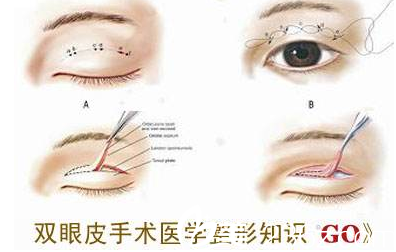 聊城韩美整形医院双眼皮介绍图 聊城韩美整形医院双眼皮介绍图