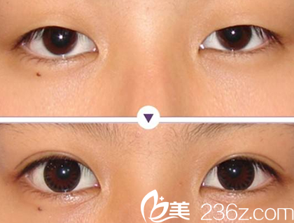 聊城韩美美容医院双眼皮案例对比图 聊城韩美美容医院双眼皮案例对比图