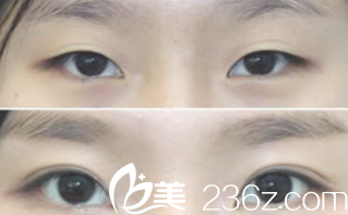 双眼皮手术前后对比 双眼皮手术前后对比