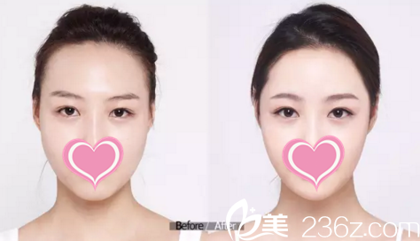 脂肪面部填充前后对比 脂肪面部填充前后对比